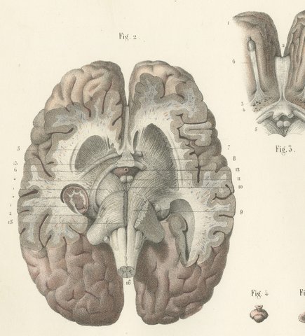 The Lateral Ventricles Opened, Antique Hirschfeld Anatomy Print, 1866, view 3