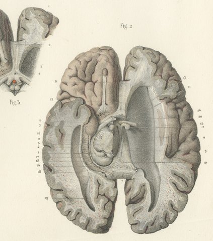 The Base of the Brain Dissected, Antique Hirschfeld Anatomy Print, 1866, view 4