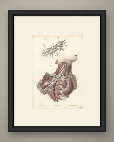 The Brachial Plexus, Antique Hirschfeld Anatomy Print, 1866, shown framed