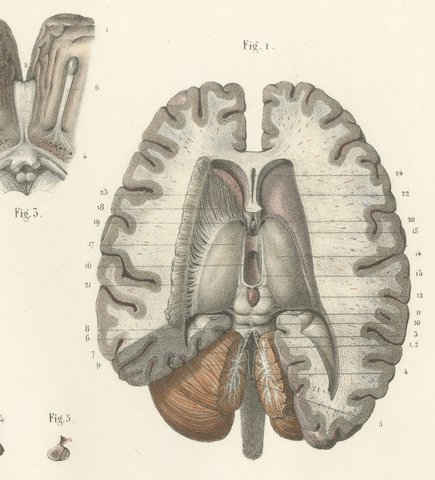 The Lateral Ventricles Opened, Antique Hirschfeld Anatomy Print, 1866, view 4