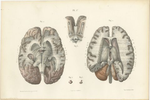 The Lateral Ventricles Opened, Antique Hirschfeld Anatomy Print, 1866, view 2