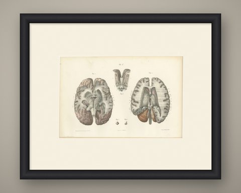 The Lateral Ventricles Opened, Antique Hirschfeld Anatomy Print, 1866, shown framed
