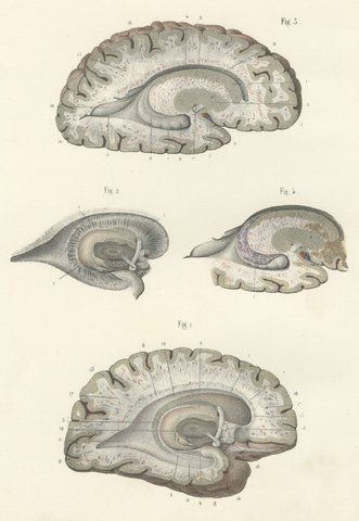 White Matter of the Cerebral Hemisphere, Antique Hirschfeld Anatomy Print, 1866