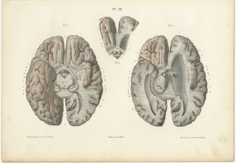 The Base of the Brain Dissected, Antique Hirschfeld Anatomy Print, 1866, view 2