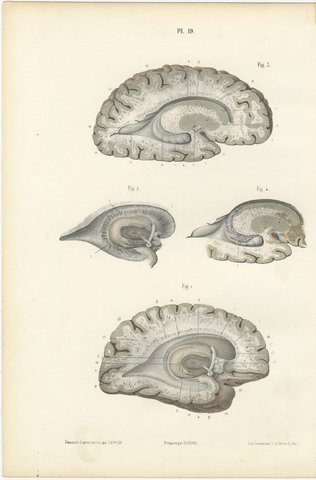 White Matter of the Cerebral Hemisphere, Antique Hirschfeld Anatomy Print, 1866, view 2