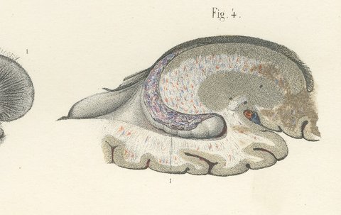 White Matter of the Cerebral Hemisphere, Antique Hirschfeld Anatomy Print, 1866, view 5