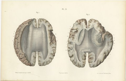 Horizontal Sections of the Cerebrum, Antique Hirschfeld Anatomy Print, 1866, view 2