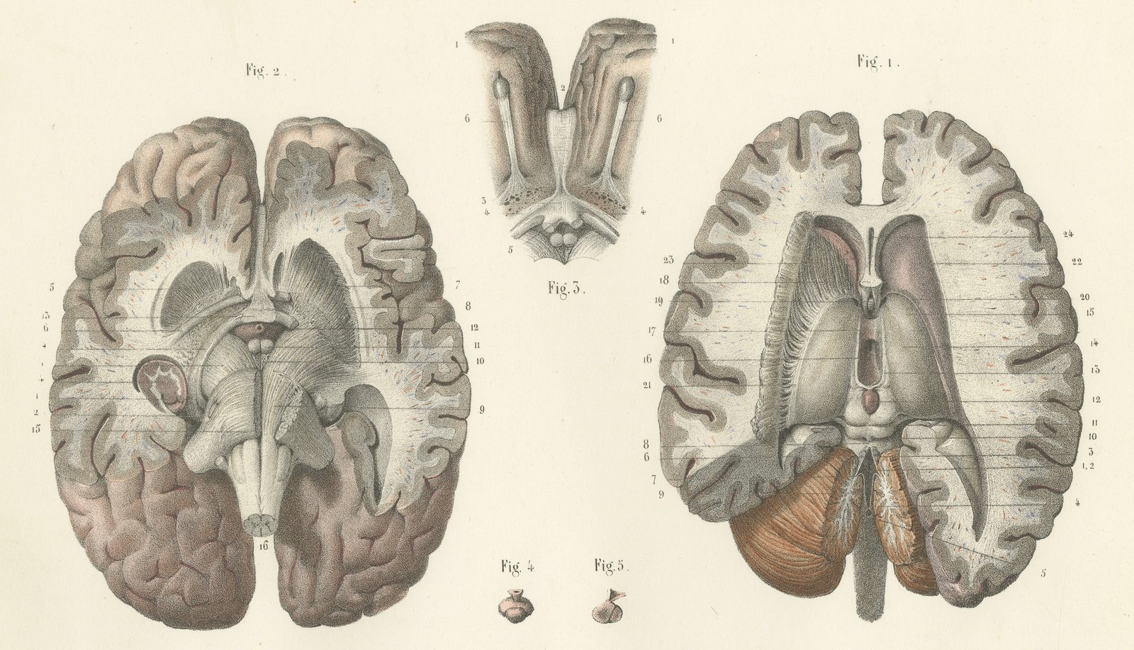 The Lateral Ventricles Opened, Antique Hirschfeld Anatomy Print, 1866