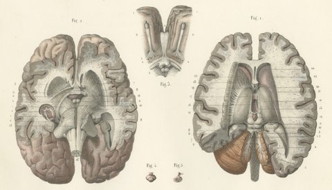 The Lateral Ventricles Opened, Antique Hirschfeld Anatomy Print, 1866
