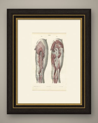The Sciatic Nerve in the Thigh, Antique Hirschfeld Anatomy Print, 1866, shown framed
