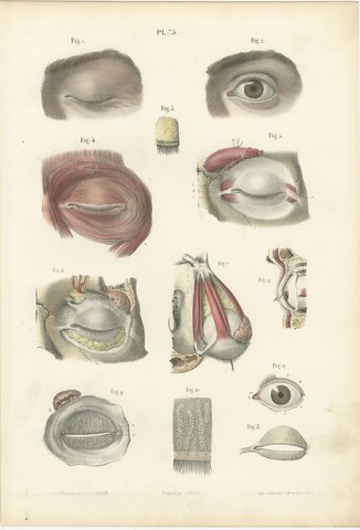 The Eyelids and Lacrimal Gland, Antique Hirschfeld Anatomy Print, 1866, view 2